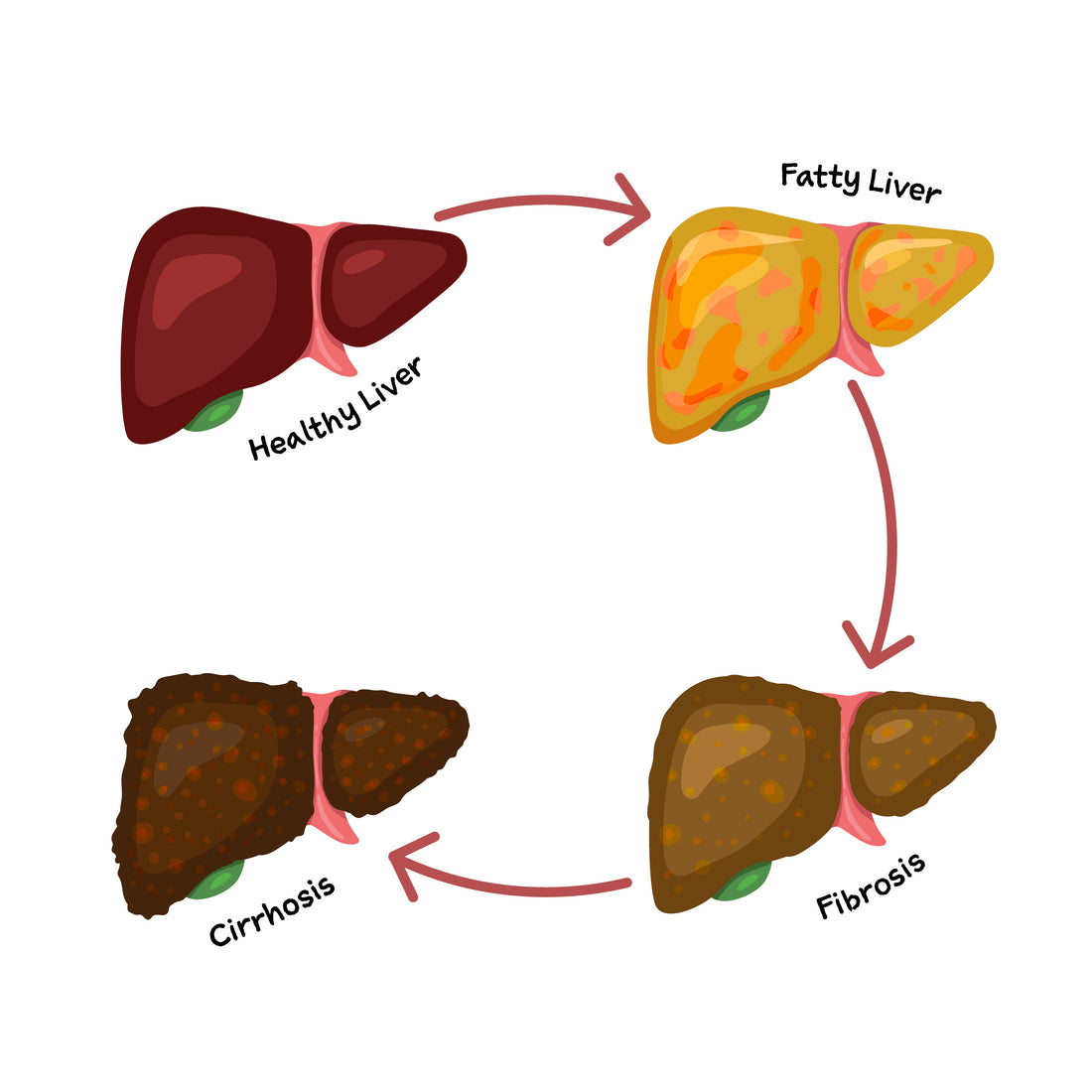 What Is Grade 1 & 2 Fatty Liver — And Can You Reverse It?